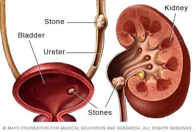How to eliminate kidney stones naturally and easily | by Food Yogi | Medium