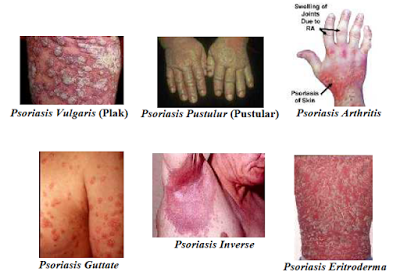 psoriasis plak adalah tenyéren pikkelysömör mint otthon kezelni