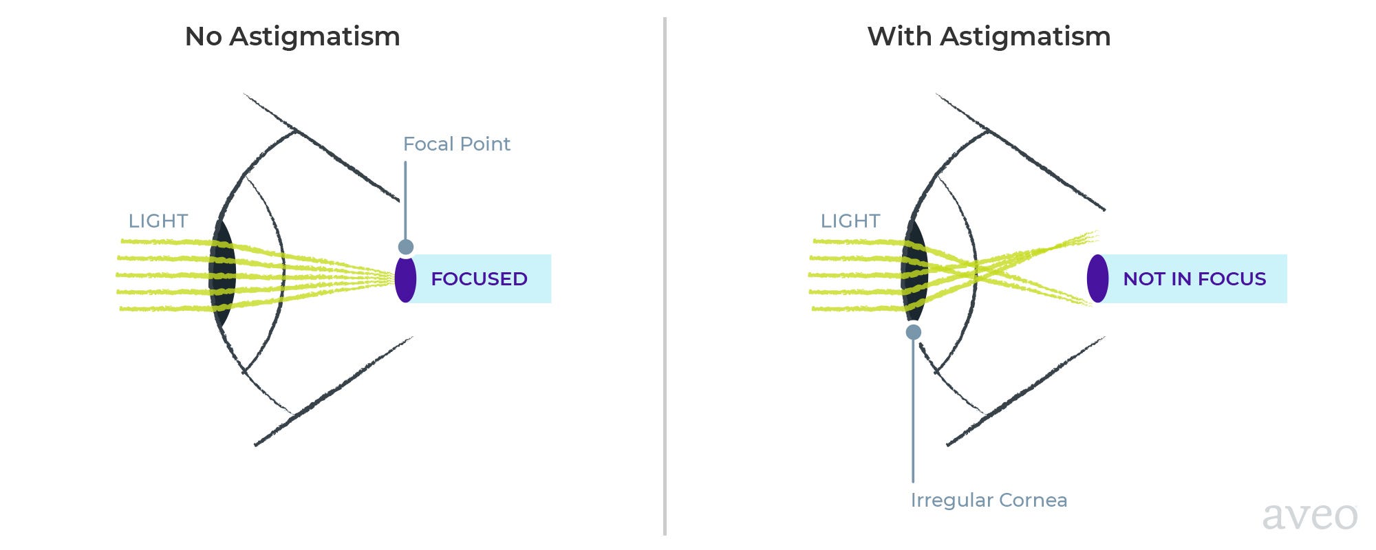 Can I Wear Contacts with Astigmatism? by Aveo Vision The Wink Medium