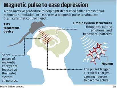 Magnet therapy shows promise in alleviating anxiety, research finds | by  Mr. Samir Singhal | Medium