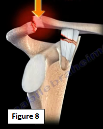 Shoulder Separation. The acromioclavicular (AC) Joint is… | by Nabil ...