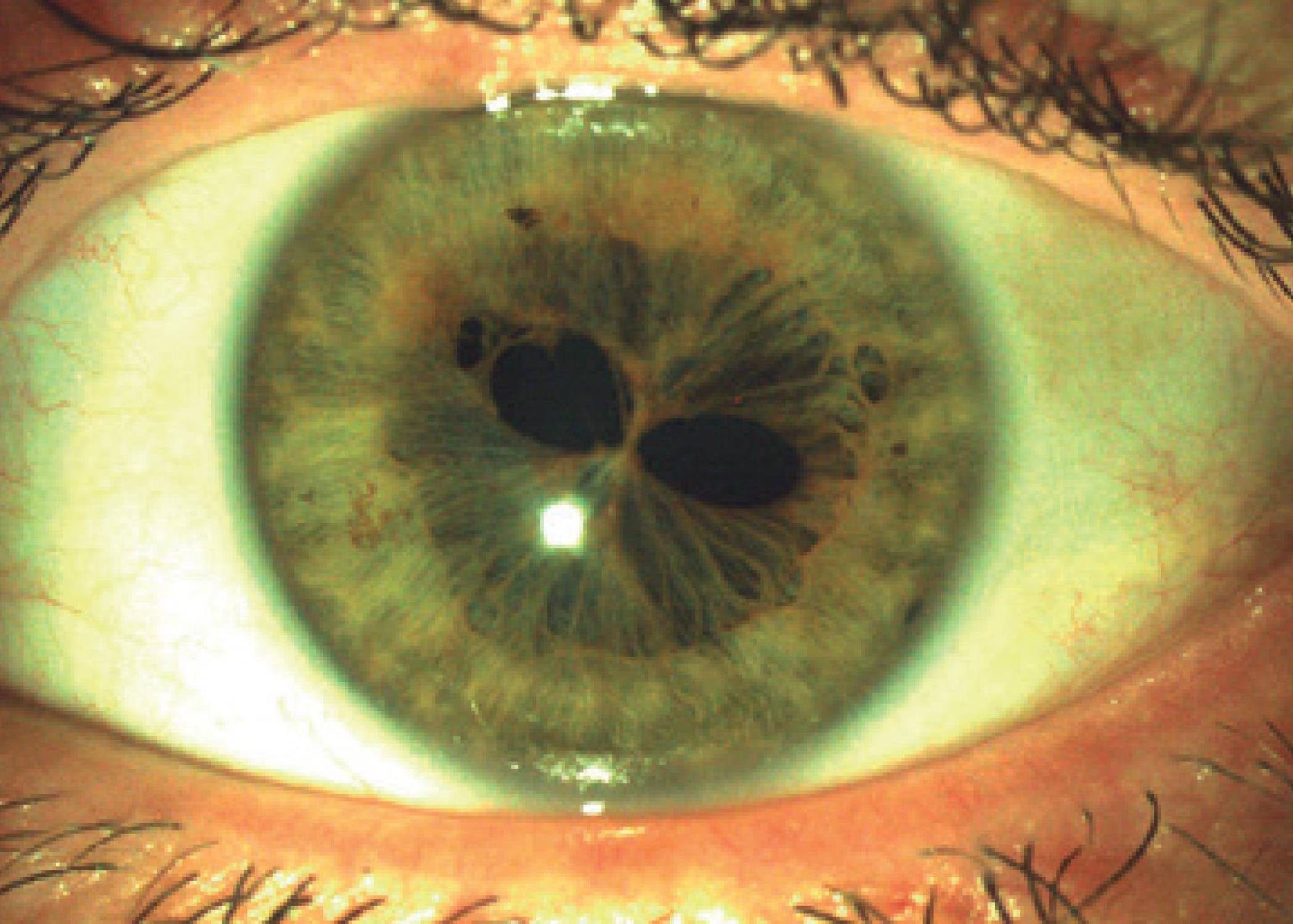 Headline: Two Pupils in One Eye? That's what Polycoria is and It's  Absolutely Insane! | by Optometry Daily | Medium