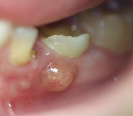 Abcesul Dentar: Cauze, Simptome si Tratament | by Dr. Ionescu Alexandru |  Medicul.Dentist | Medium