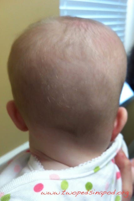 my baby has a flat head at 3 months