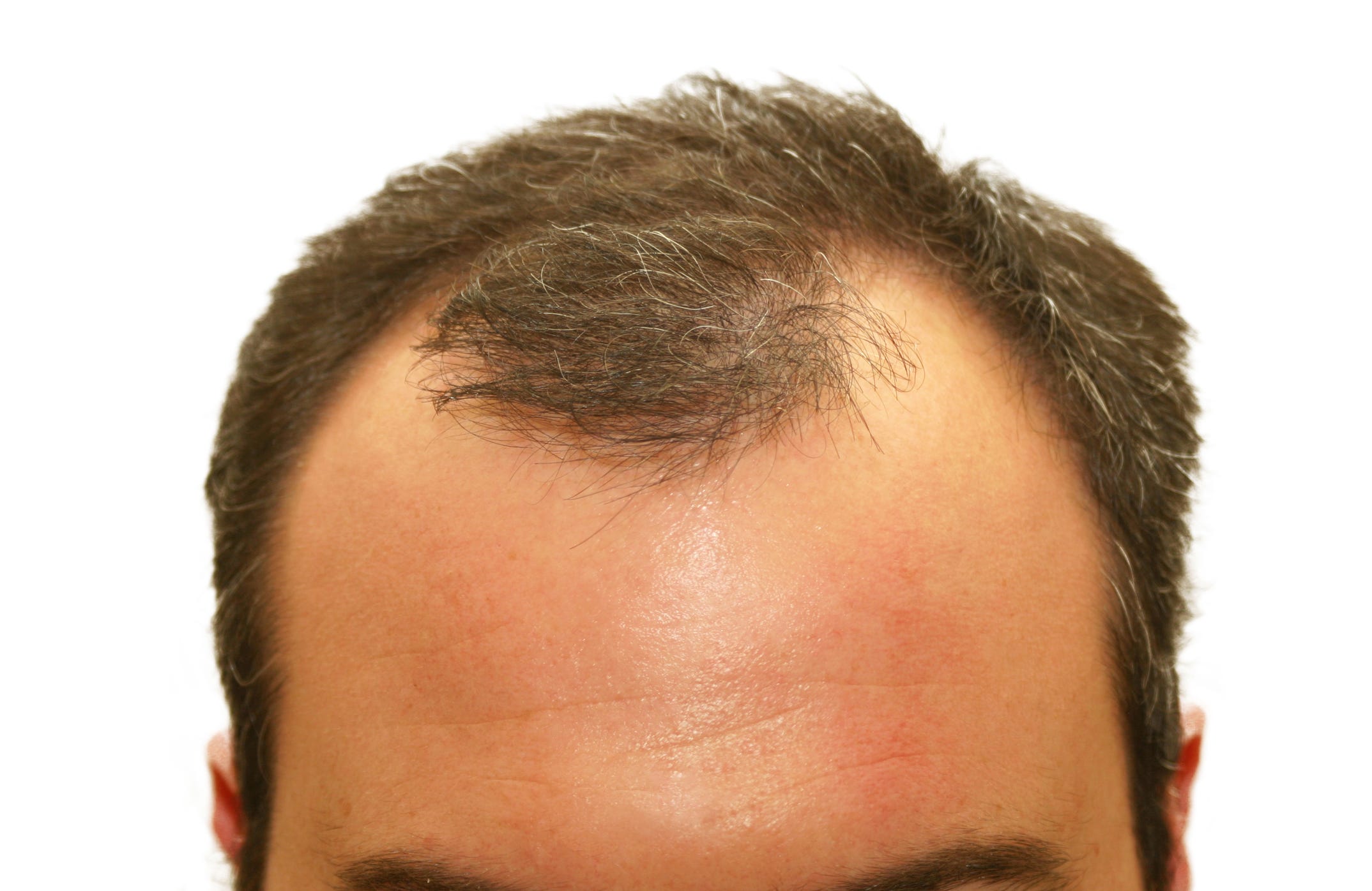 Treating Hair Loss Problem Samarth Sonawane Medium