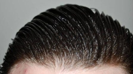 Oily Hair Treatment In Delhi Procedure Effects And Advantages