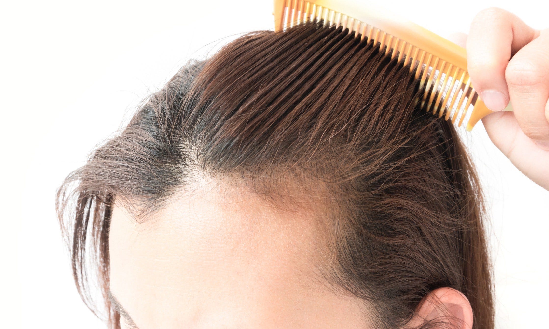 Causes Prevention And Proper Treatment Of Hair Loss Alopecia In Women