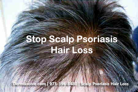 Scalp Psoriasis Hair Loss Psorasis Treatment Medium