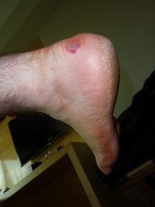 heel blister