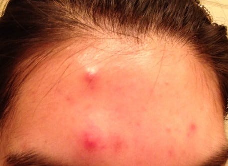 A Message From The Big Ass Pimple On Your Forehead By Safetypuppy Medium
