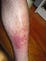 cure skin disease