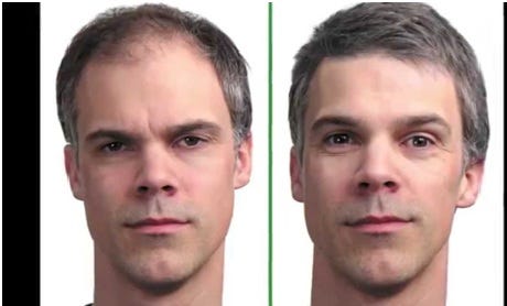 Artificial Hair Transplant Shawn Daniels Medium