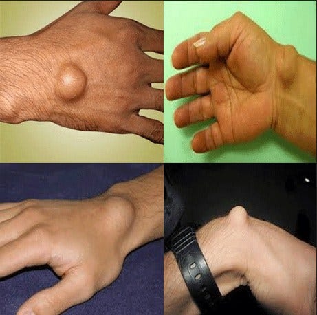 Kista Ganglion Amashusho Images