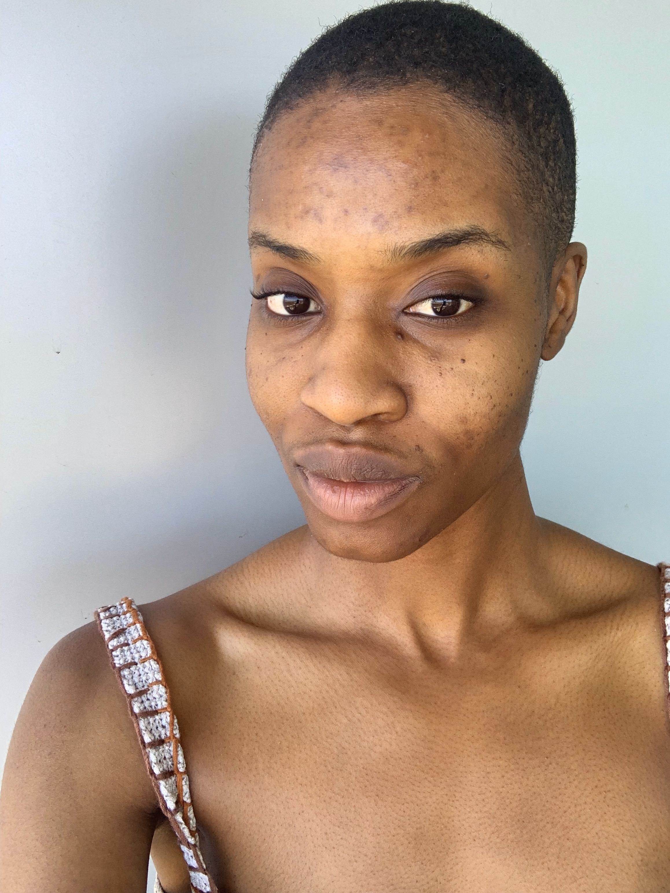 Pomade acne? Here’s what to do.. A quick guide to hair