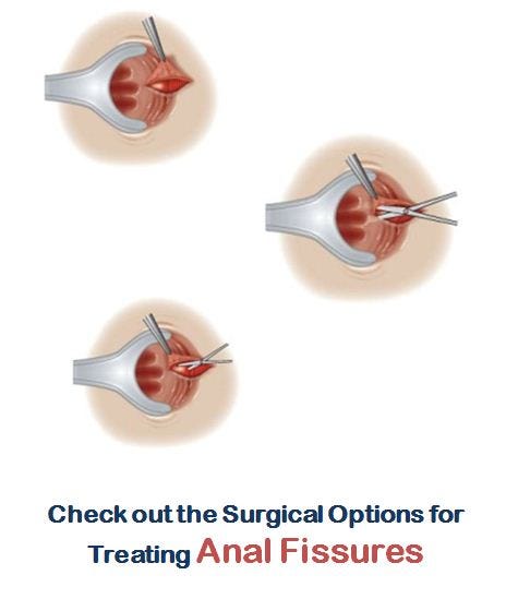 A Guide To Know About Anal Fissure Its Symptoms, Causes And Treatment