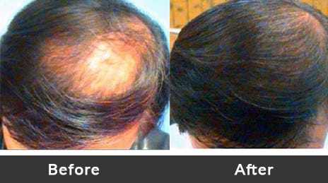Early Signs Of Balding In Men Preeti Gupta Medium