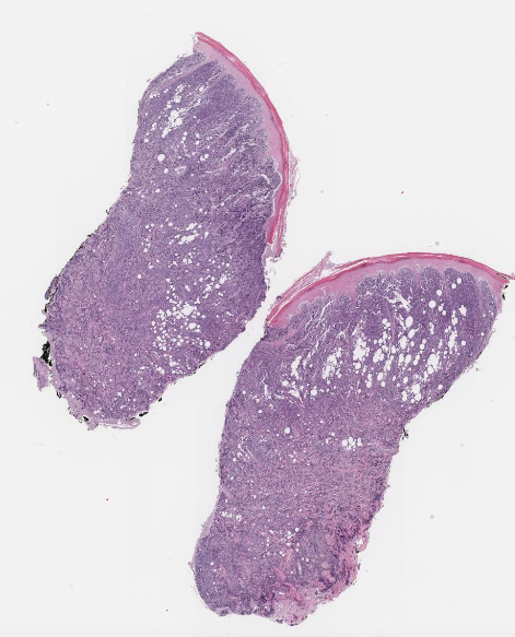 Primary Cutaneous Diffuse Large B-Cell Lymphoma, Leg-Type | By Siba El ...