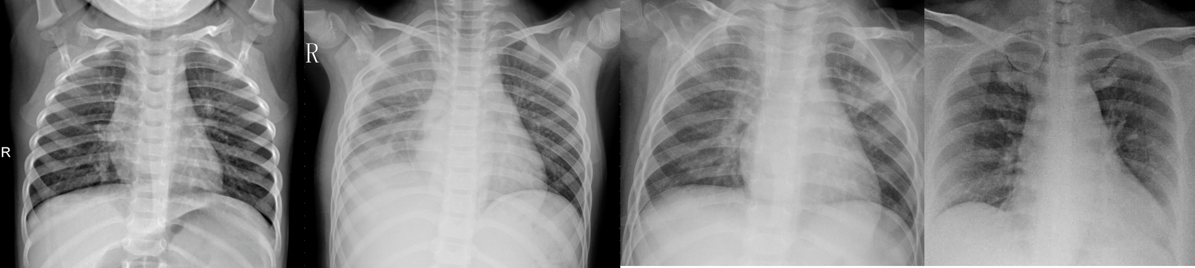 Detecting Covid 19 Induced Pneumonia From Chest X Rays With Transfer Learning An Implementation In Tensorflow And Keras By Adrian Yijie Xu Towards Data Science
