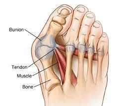 Bunion Pain Physiotherapy. A bunion, also known as hallux valugus… | by Wohl Physio | Medium Bunion Pain Physiotherapy. A bunion, also known as hallux valugus… | by Wohl Physio | Medium