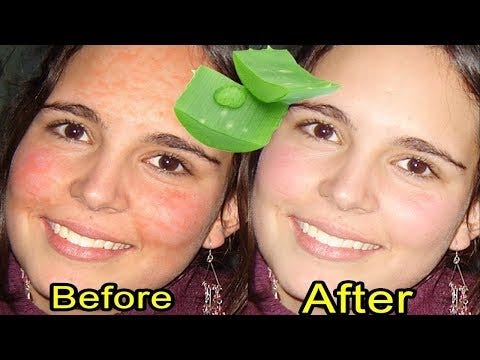 back acne aloe vera
