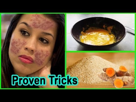 homemade acne treatment
