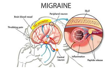 Migraine Does A Body Good If You Suffer From Migraines The Best By Nutrition With Judy Medium migraine does a body good if you