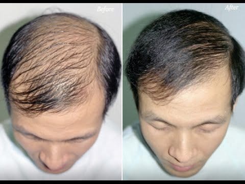 A Revolutionary Solution To Hair Loss Jorden Vali Medium