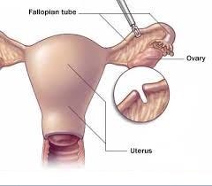 Tubal Ligation Reversal Surgery Procedure Tubal Reversal Surgery By Alisa Kansakar All Treatment Medium