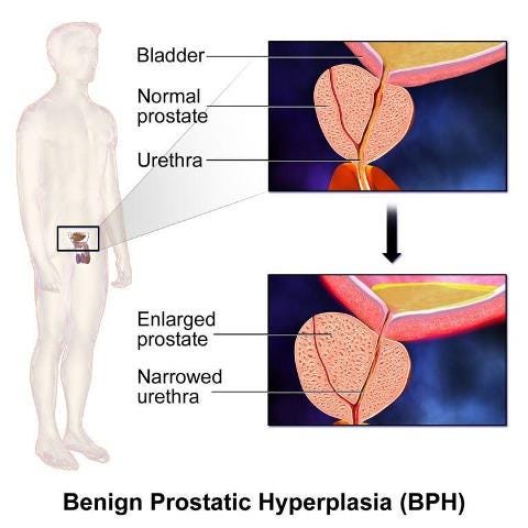 benign prostatic hyperplasia (bph) is characterized by