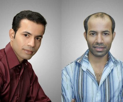Hair Transplant Cost In Lahore John Player Medium
