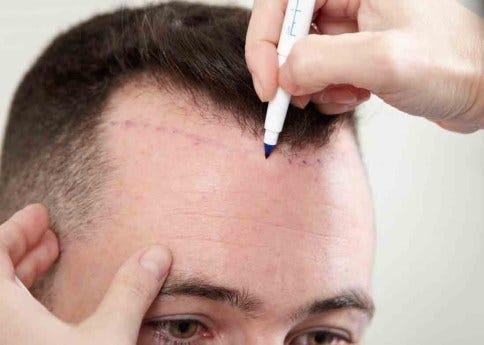 Hair Transplant Treatment Questions And Answers Bulletin Echo