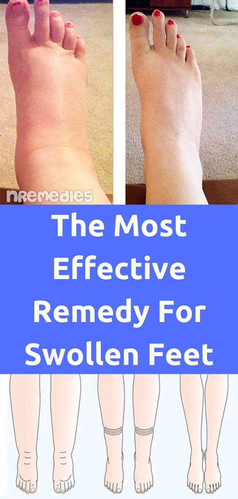 Reduce Water Retention With Best 10 Natural Remedies