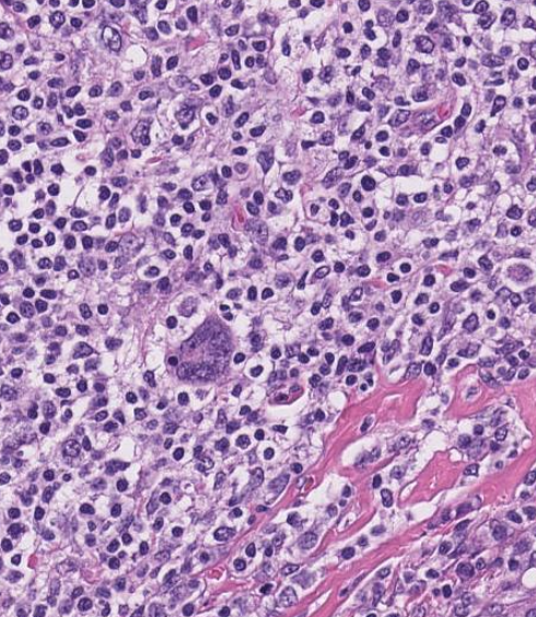 Extra Nodal Marginal Zone Lymphoma with Reed-Sternberg-Like Cells | by ...