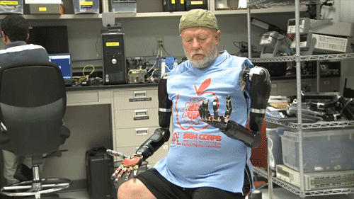 A man with prosthetic arms.