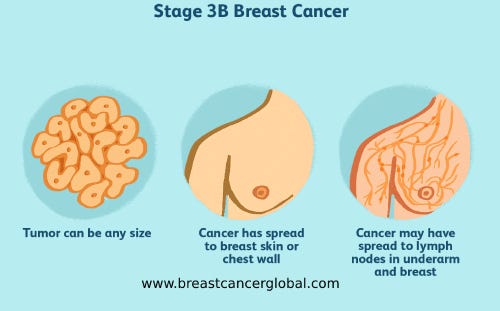 What Is The Meaning Of Stage 3 Breast Cancer By Breast Cancer Breast Information Breast Global Medium