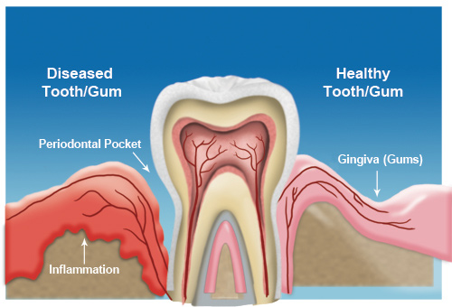 home remedy gum abscess stages