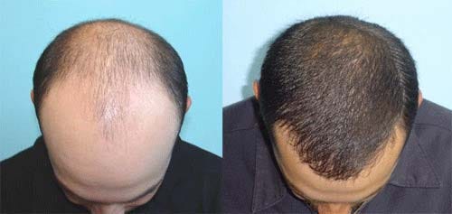 Know The Difference Between Hairs Weaving Vs Hair Transplant