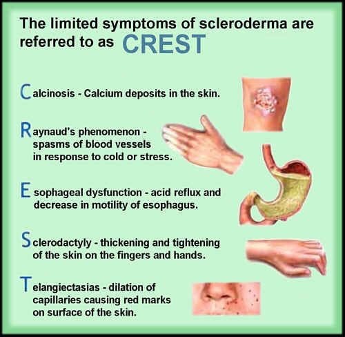 CREST Syndrome, Limited scleroderma | by Jeanette Calara | Medium