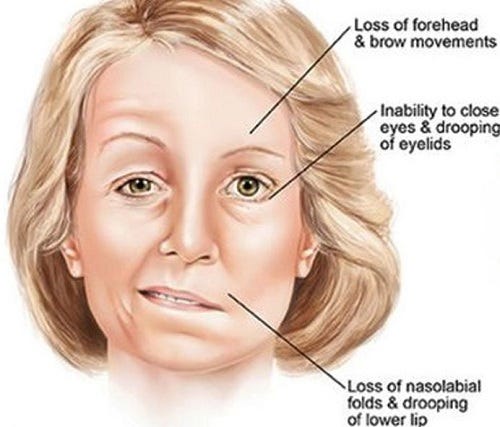 What Happens When You Have Facial Palsy By Dr Kavreen Arora Medium What Happens When You Have Facial Palsy By Dr Kavreen Arora Medium