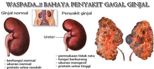Unduh 6800 Koleksi Gambar Gagal Ginjal Akut Terbaik 