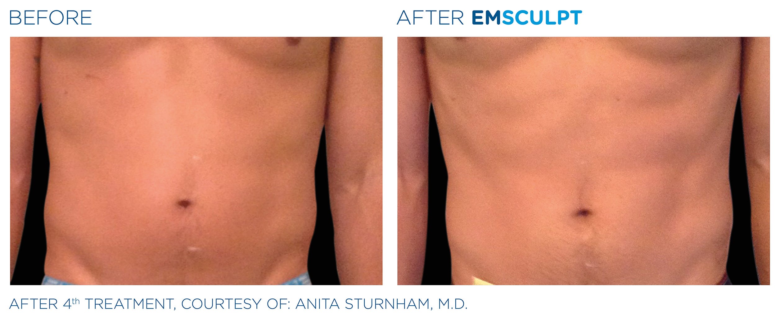 Body Sculpting Treatment What To Do Before And After A Procedure By New Radiance Emsculpt Medium