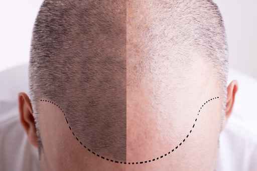 ordre finasteride