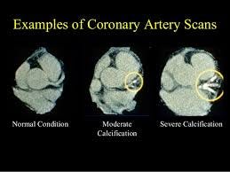 Why You Must Know If Your Heart Calcium Score Is Zero By Joel Kahn Medium