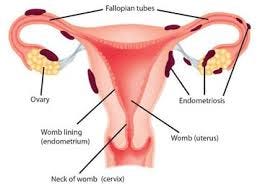Different Types Of Blocked Fallopian Tubes Mohak Ivf Medium
