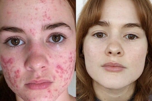 Cara Mengatasi Jerawat Secara Alami Obat Herbal Asli