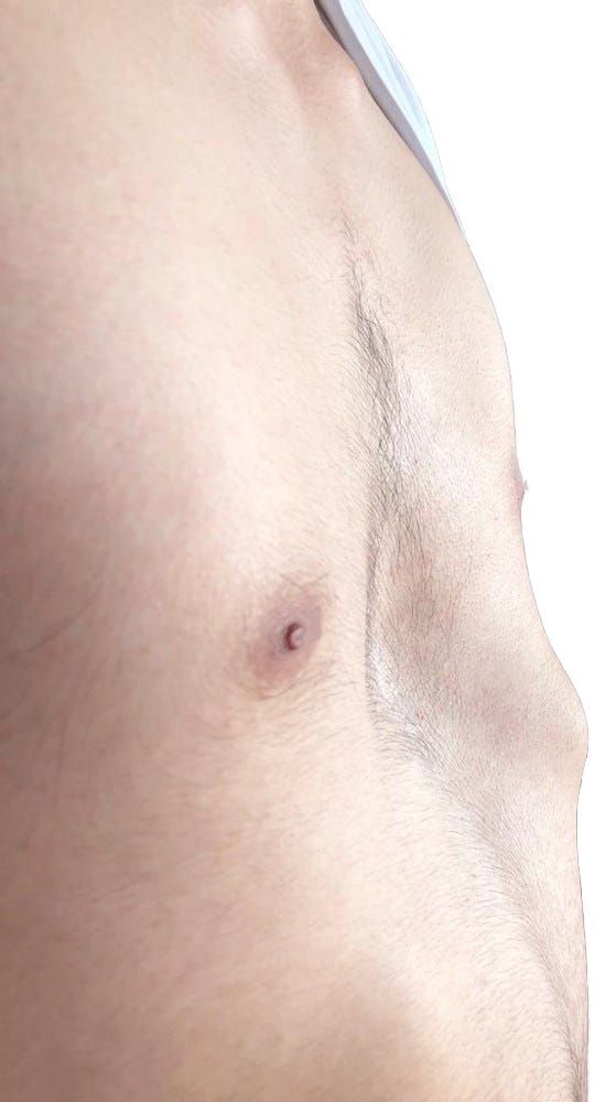 IPectus Excavatum , Kunduracı Göğsü Ameliyatı by Eren