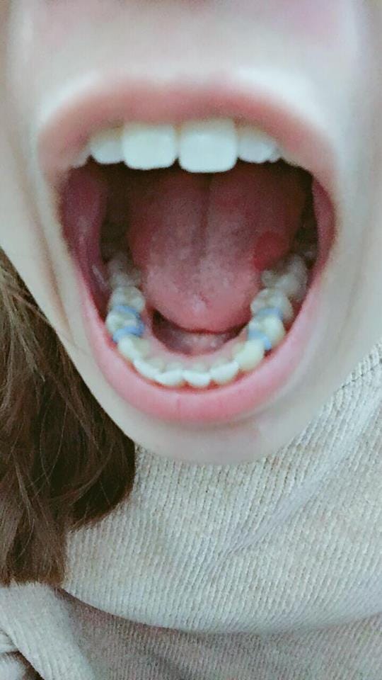 牙齒矯正2 在要拔的牙齒上戴橡皮筋 今天約晚上七點去嘉安牙醫報到 晚上還吃了輔大對面的老葉牛肉麵 我姐今天去輔仁醫院 By Wyatt Medium