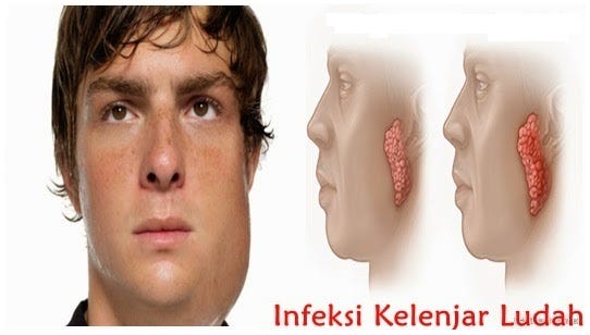 Obat Infeksi Kelenjar Ludah Bengkak By Reni Syafitri Medium