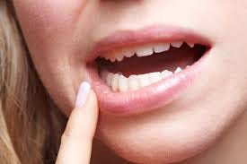 What Does Abreva Do To A Cold Sore By William Miller Medium