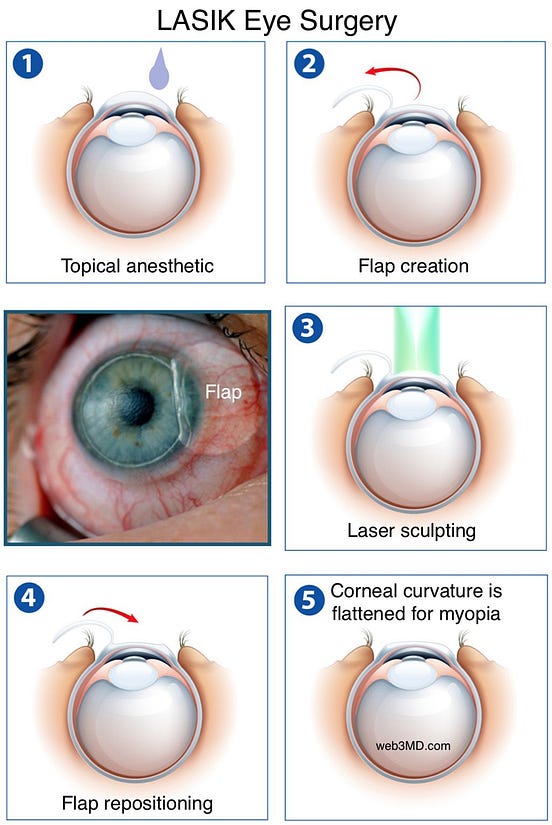 My LASIK Eye Surgery Experience. This article is not written by a… by